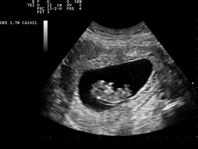 Ultrasound Scan ND 0105143736 1439323